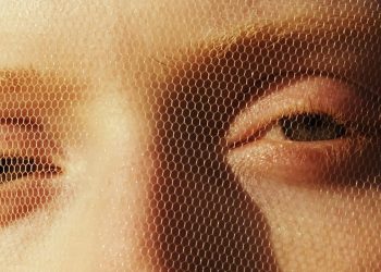 How Safe Is Radiofrequency Microneedling, Really?